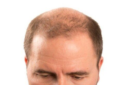 7 Stages of Male Pattern Baldness You Should Know 19